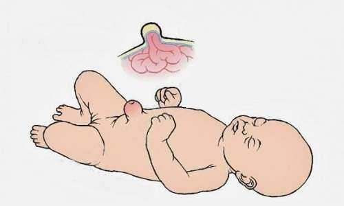 Как заклеить пупочную грыжу у новорожденных