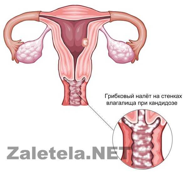 Молочница при беременности симптомы у женщин