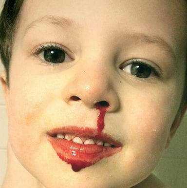 От чего идет кровь из носа у ребенка часто