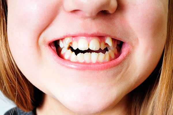 Прикус зубов у детей правильный и неправильный